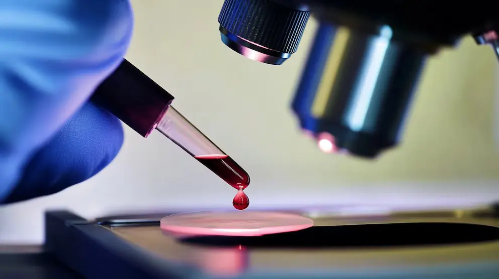 Parkinson hastalığının belirtileri ortaya çıkmadan önce tespit edilebilecek kan biyobelirteçleri